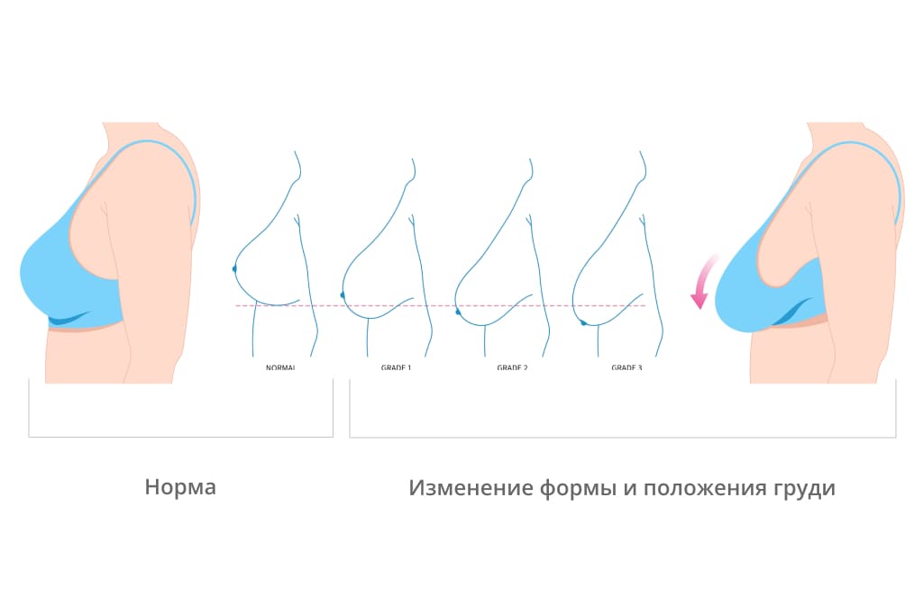 Показания к подтяжке груди показания к подтяжке груди
