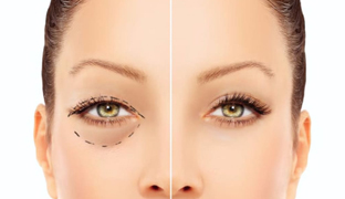 Блефаропластика