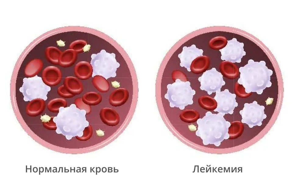 Лейкоз Лейкоз