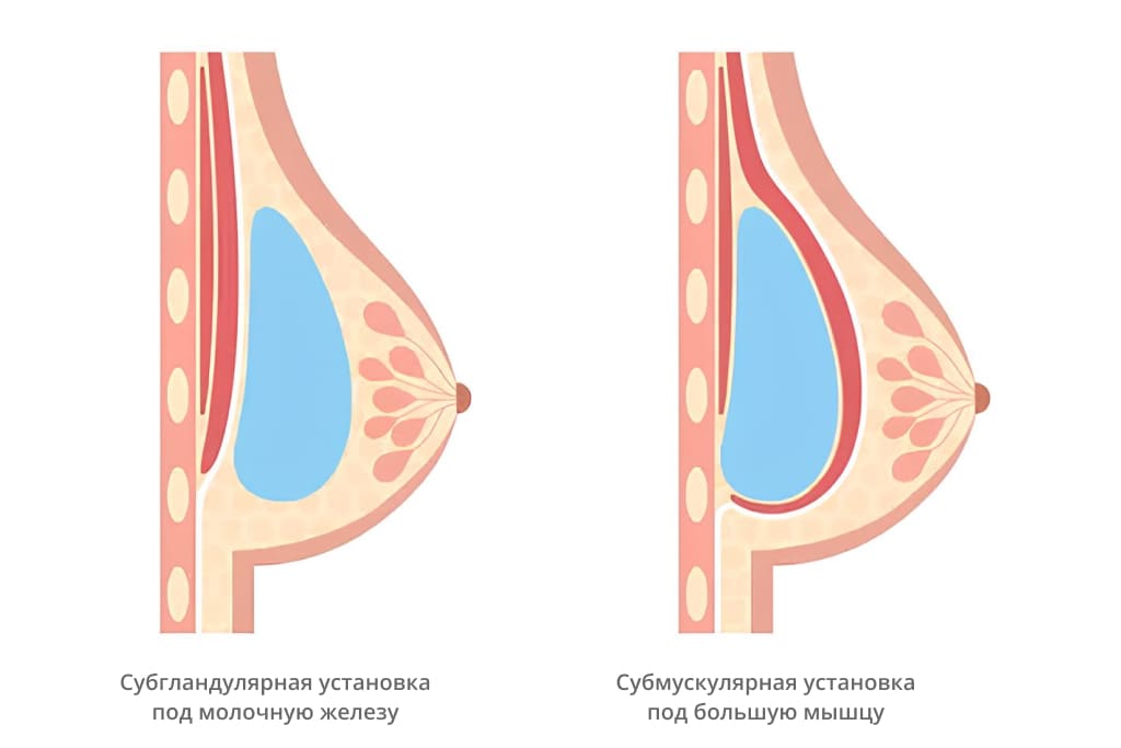 Способы увеличения груди Способы увеличения груди