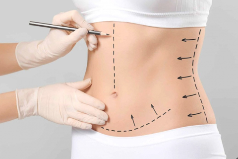 Операция по подтяжке тела Операция по подтяжке тела