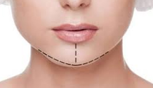 Ментопластика (пластика подбородка)