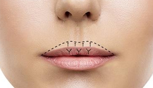 пластика губ (хейлопластика)