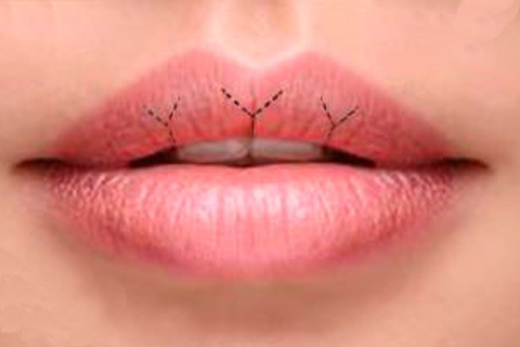 Пластика губ: метод V–Y Пластика губ: метод V–Y