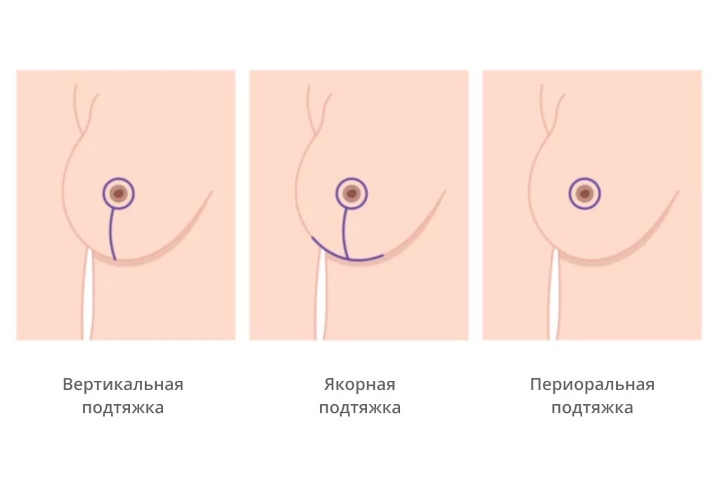 Способы подтяжки груди способы подтяжки груди