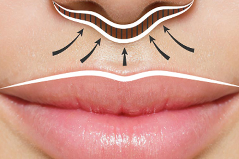 Пластика губ: метод Булхорн хейопластика: метод Булхорн