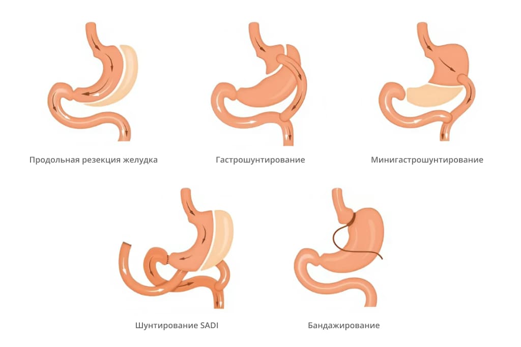 Виды бариатрической хирургии виды бариатрической хирургии