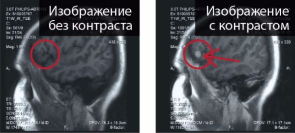 мрт головного мозга с контрастированием