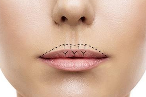 Пластика губ Пластика губ