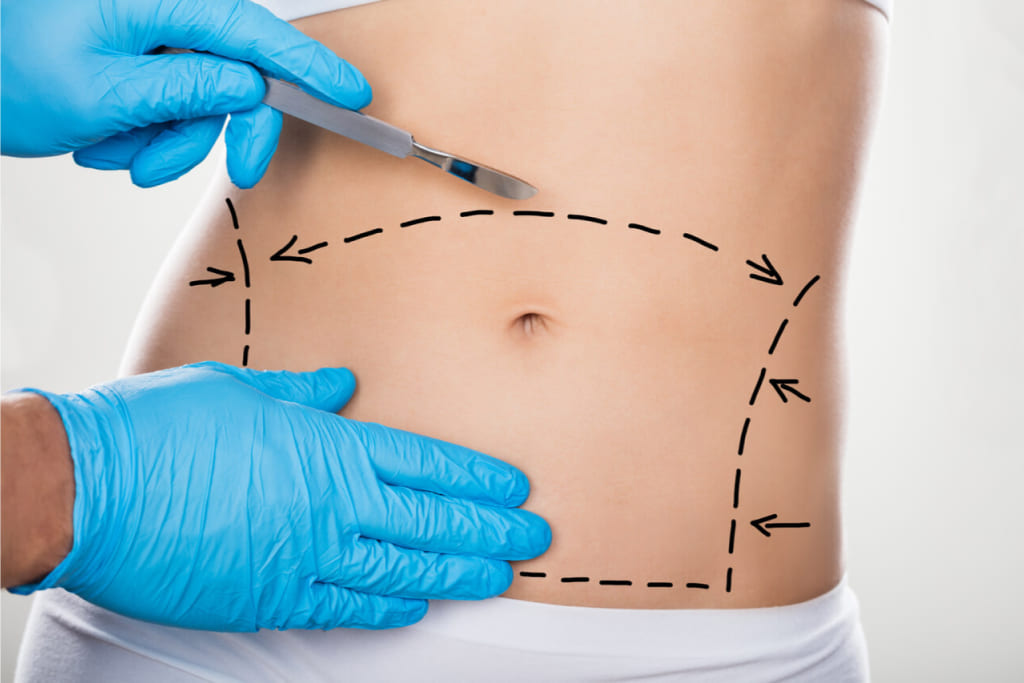 Виды абдоминопластики живота виды абдоминопластики живота