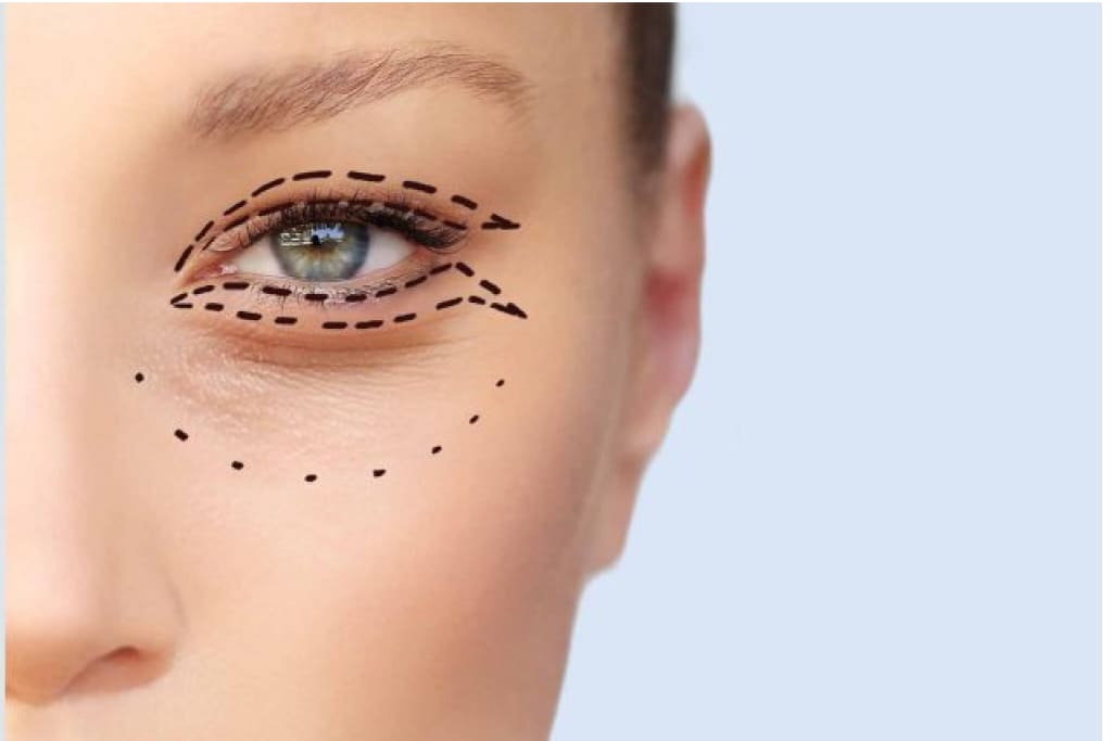 Виды блефаропластики виды блефаропластики