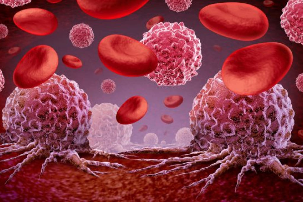 Онкогематология: миелома Онкогематология: миелома