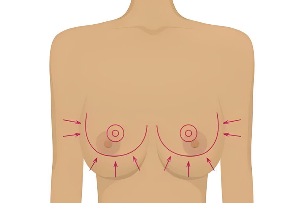 Способ уменьшения груди способ уменьшения груди
