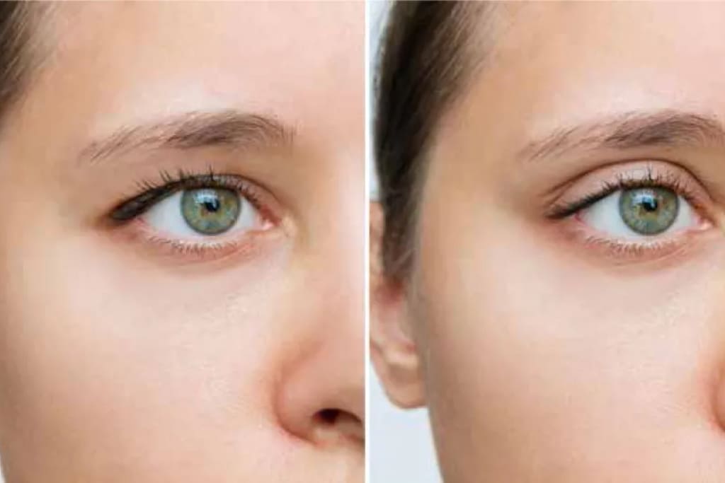 Результаты блефаропластики результаты блефаропластики