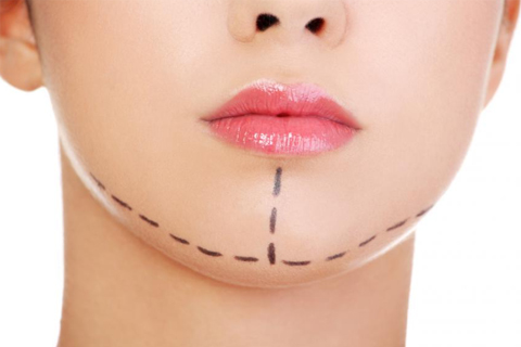 Ментопластика подбородка Ментопластика подбородка