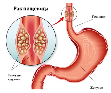 Лучевая терапия при опухоли пищевода без стеноза 1.jpg