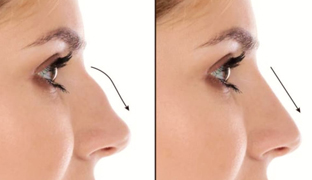 ринопластика