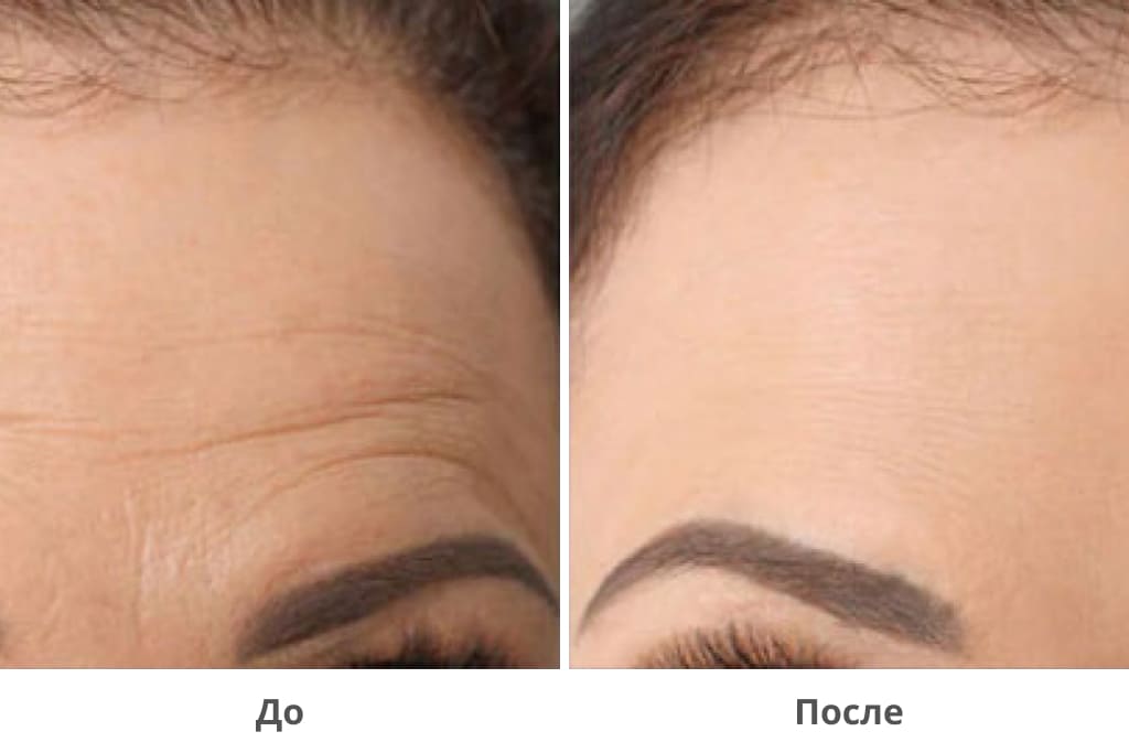Эндоскопический лифтинг лба: до и после Эндоскопический лифтинг лба: до и после