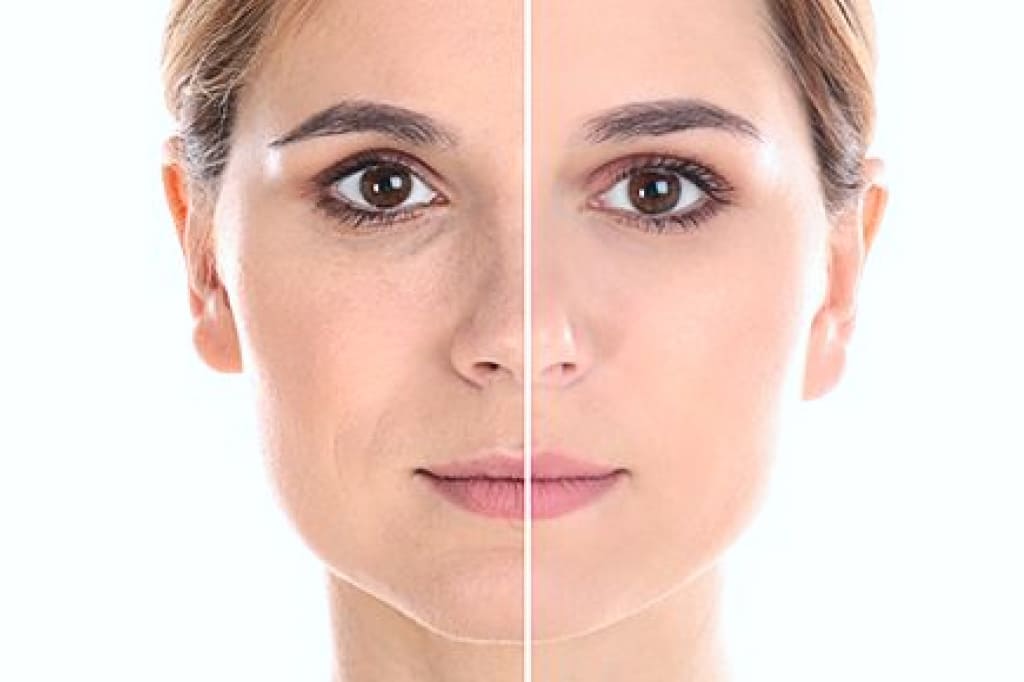 Подтяжка средней зоны лица: до и после Подтяжка средней зоны лица: до и после