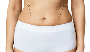 Абдоминопластика